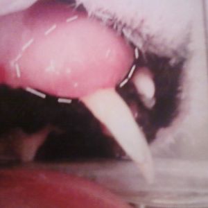Extracted Upper Canine Tooth - Constant Sore on Lip