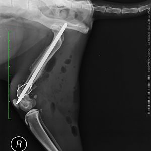 Question about removing the plates after tibial fracture surgery